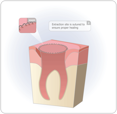 Oral Surgery Wisdom Teeth 24